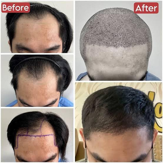 Revitalize Studios - Hair Transplant Centre in Jalandhar Punjab India