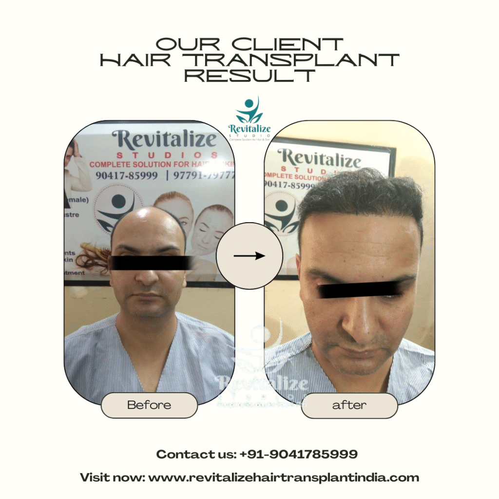 Full scalp hair transplant before and after India – FUE + FUT technique