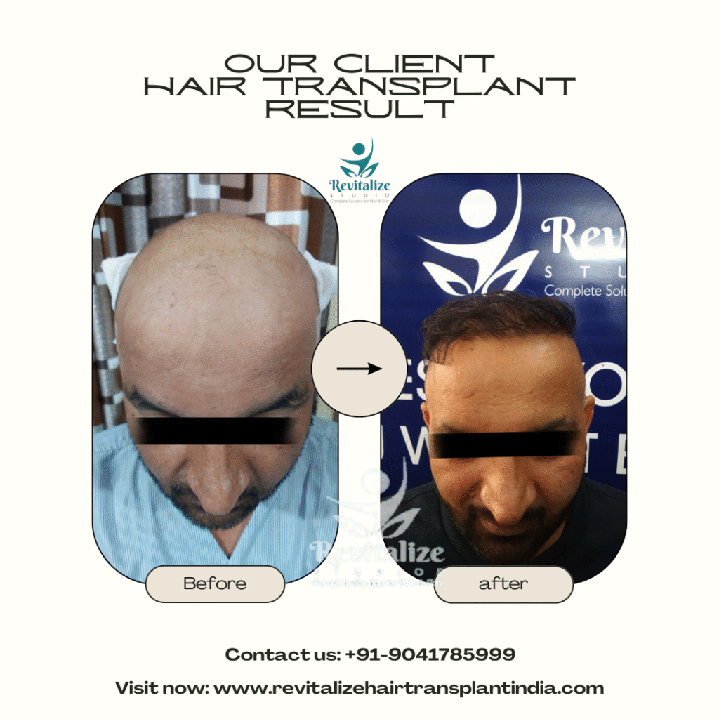 FUT hair transplant before and after results natural hairline India