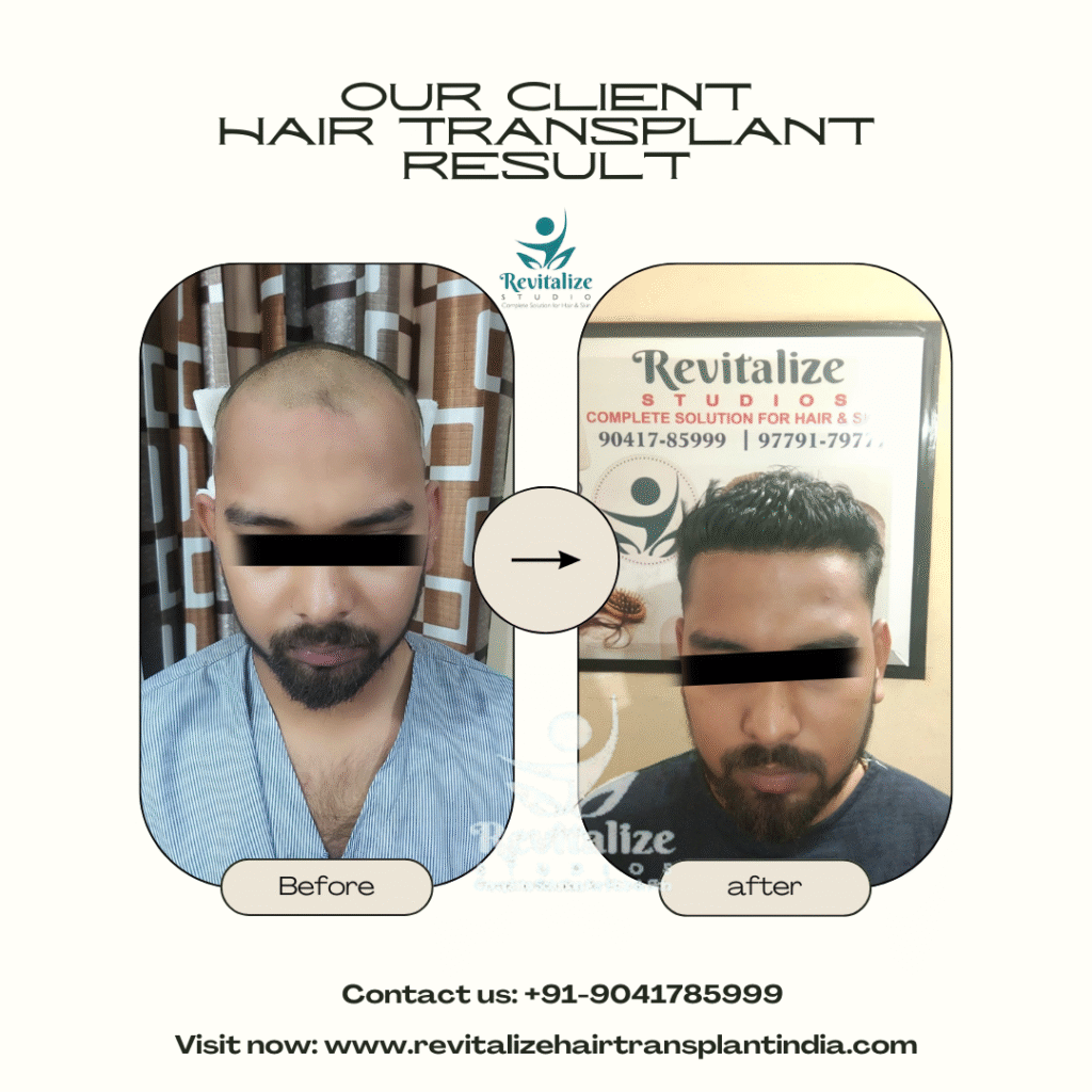 Male pattern baldness hair transplant before and after results India