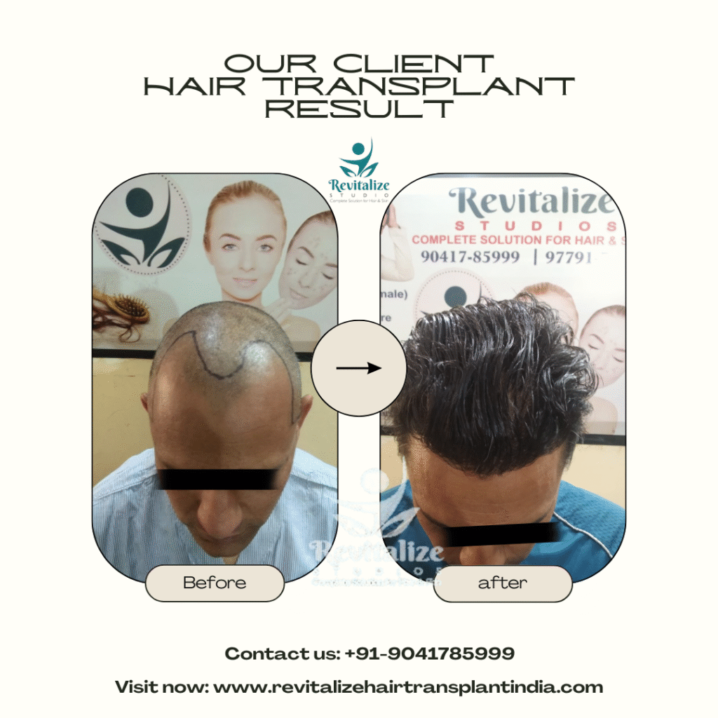 Alt Text: Hair transplant before and after density improvement India