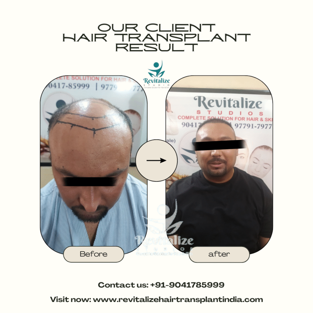 Celebrity hair transplant before and after results India