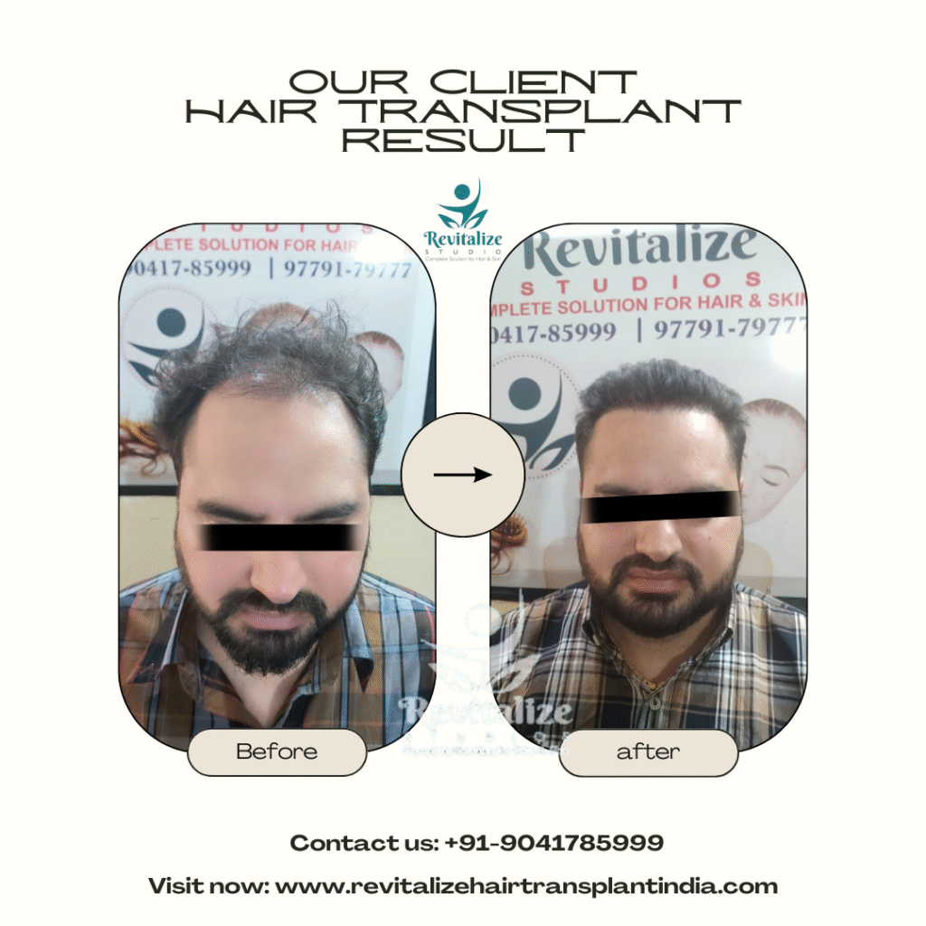 Best hair transplant before and after results India – restored natural hairline