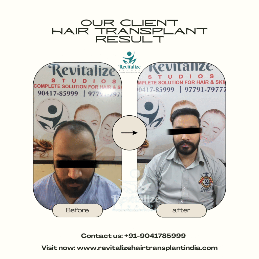 International patient hair transplant before and after results India