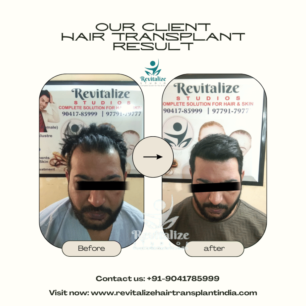 FUT hair transplant before and after results India – full scalp transformation