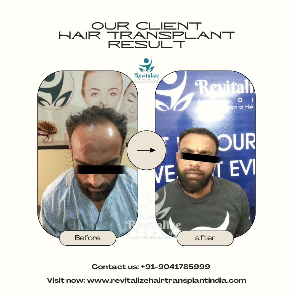PRP hair treatment before and after results India – natural regrowth