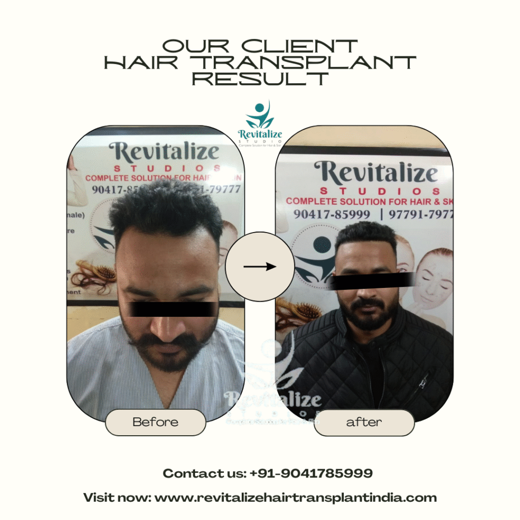 Hair transplant before and after crown bald spot treatment India