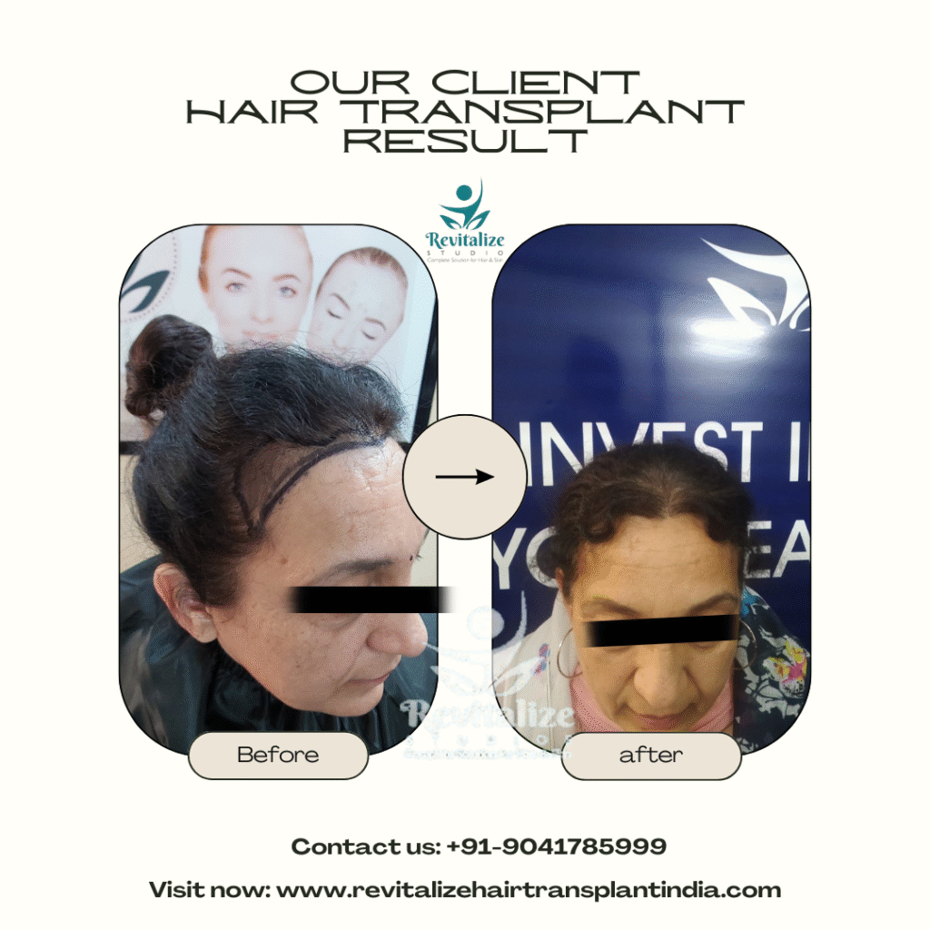 Female hair transplant before and after results India – natural hairline restoration