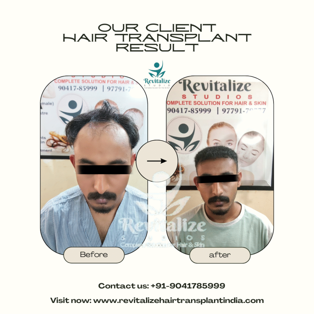 FUE hair transplant before and after results in India – male receding hairline restored