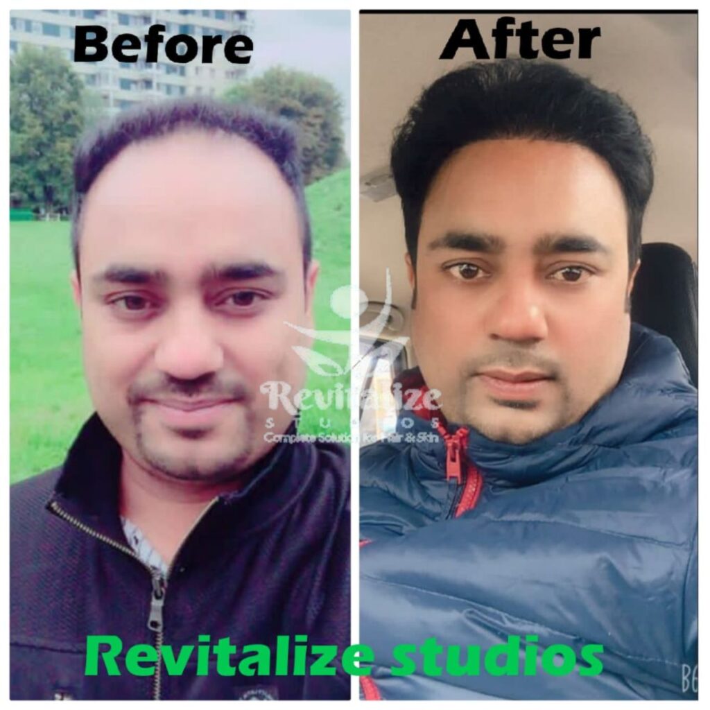 Hair Transplant Jalandhar, Hair Transplant Near Me, Hair Transplant Clinic Jalandhar, Best Hair Transplant Jalandhar, Affordable Hair Transplant Jalandhar, FUE Hair Transplant Jalandhar, FUT Hair Transplant Jalandhar, Beard Transplant Jalandhar, Eyebrow Hair Transplant Jalandhar, Hair Loss Treatment Jalandhar, Hair Restoration Jalandhar, Revitalize Studios Hair Transplant Jalandhar, Hair Transplant Punjab, Hair Transplant Near Jalandhar Villages, Hair Transplant Phagwara, Hair Transplant Kartarpur, Hair Transplant Nurmahal, Hair Transplant Adampur, Hair Transplant Jandiala, Hair Transplant Goraya, Hair Transplant Shankar, Hair Transplant Morinda, Hair Transplant Nakodar, Hair Transplant Lohian, Hair Transplant Basti Jodhewal, Hair Transplant Bhogpur, Hair Transplant Urmar, Hair Transplant Balachaur, Hair Transplant Sultanpur Lodhi, Hair Transplant Kapurthala, Hair Transplant Mehatpur, Hair Transplant Talwandi Bhai, Hair Transplant Dhilwan, Hair Transplant Sunam, Hair Transplant Rurka Kalan, Hair Transplant Phullanwal, Hair Transplant Mahilpur, Hair Transplant Bhawanigarh