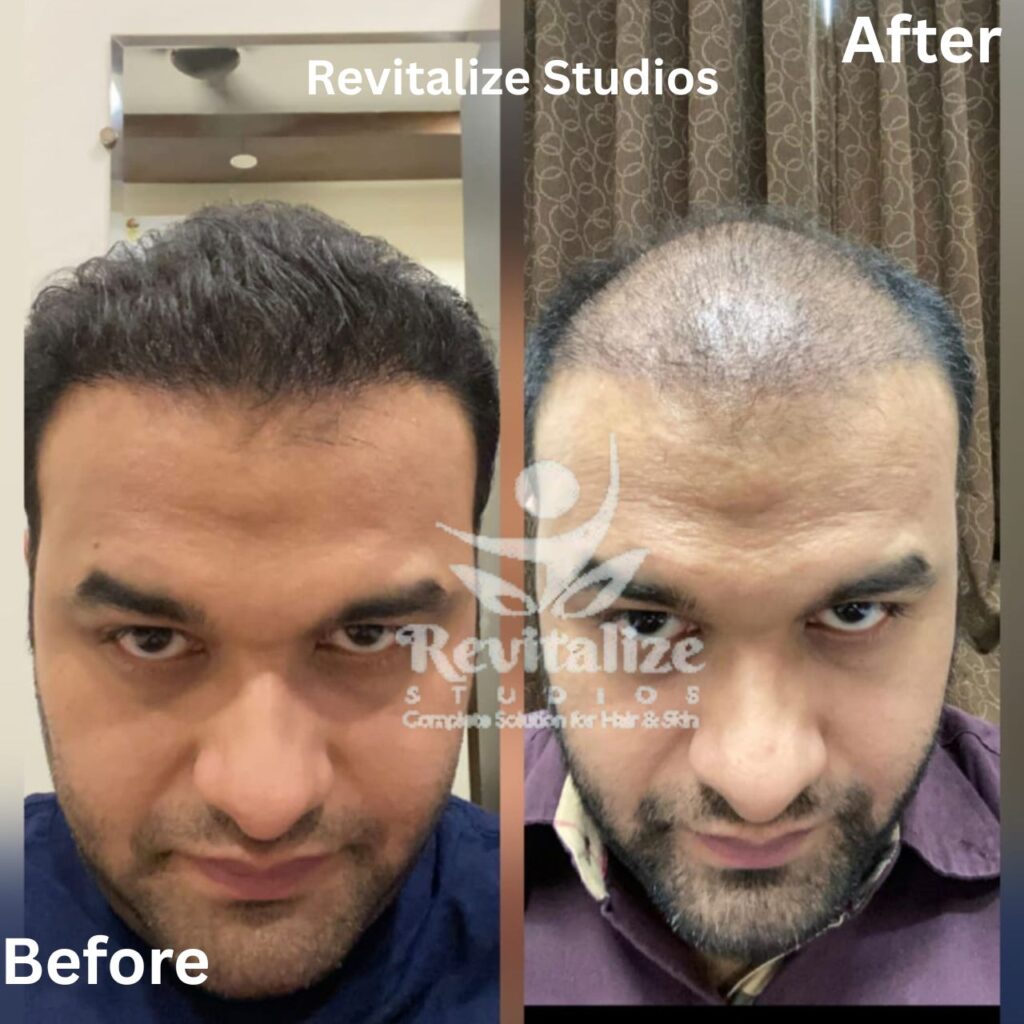 Hair Transplant Jalandhar, Hair Transplant Near Me, Hair Transplant Clinic Jalandhar, Best Hair Transplant Jalandhar, Affordable Hair Transplant Jalandhar, FUE Hair Transplant Jalandhar, FUT Hair Transplant Jalandhar, Beard Transplant Jalandhar, Eyebrow Hair Transplant Jalandhar, Hair Loss Treatment Jalandhar, Hair Restoration Jalandhar, Revitalize Studios Hair Transplant Jalandhar, Hair Transplant Punjab, Hair Transplant Near Jalandhar Villages, Hair Transplant Phagwara, Hair Transplant Kartarpur, Hair Transplant Nurmahal, Hair Transplant Adampur, Hair Transplant Jandiala, Hair Transplant Goraya, Hair Transplant Shankar, Hair Transplant Morinda, Hair Transplant Nakodar, Hair Transplant Lohian, Hair Transplant Basti Jodhewal, Hair Transplant Bhogpur, Hair Transplant Urmar, Hair Transplant Balachaur, Hair Transplant Sultanpur Lodhi, Hair Transplant Kapurthala, Hair Transplant Mehatpur, Hair Transplant Talwandi Bhai, Hair Transplant Dhilwan, Hair Transplant Sunam, Hair Transplant Rurka Kalan, Hair Transplant Phullanwal, Hair Transplant Mahilpur, Hair Transplant Bhawanigarh, Hair Transplant Dhangu Road, Hair Transplant Sujanpur, Hair Transplant Abrol Nagar, Hair Transplant Mission Road, Hair Transplant Badhani, Hair Transplant Pinjore, Hair Transplant Bungal, Hair Transplant Haryal, Hair Transplant Jandwal, Hair Transplant Municipal Colony, Hair Transplant Shahpur Kandi, Hair Transplant Dharkalan