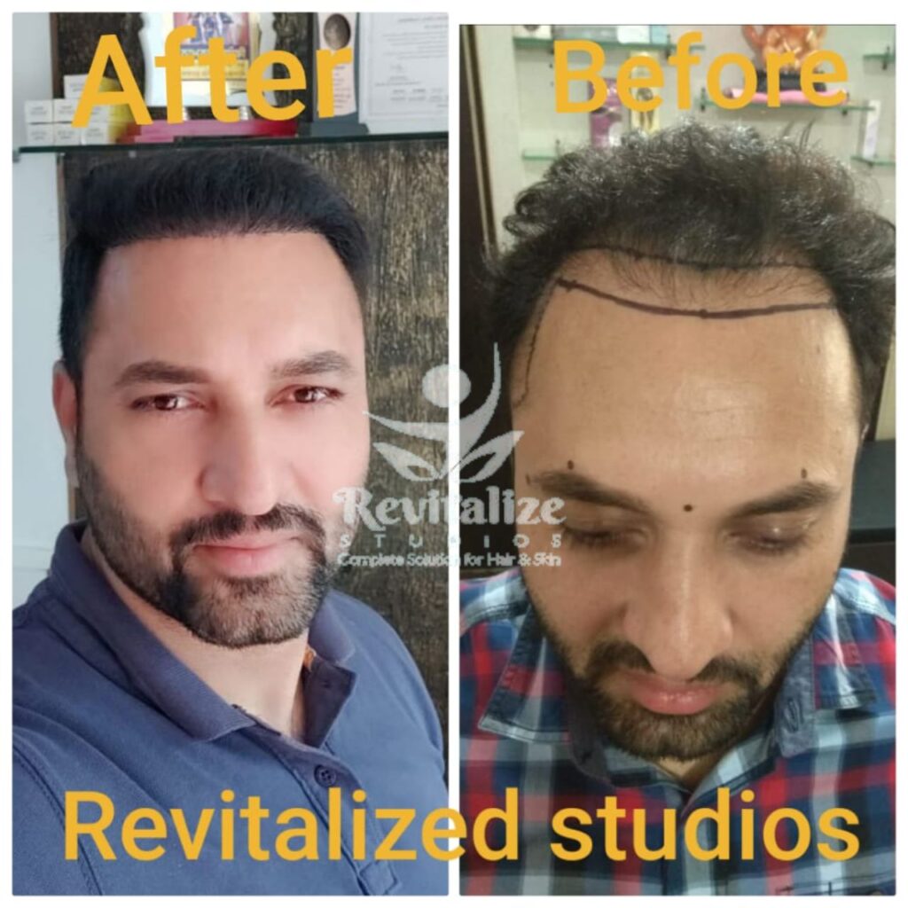 Hair Transplant Nabha, Hair Transplant Samrala, Hair Transplant Doraha, Hair Transplant Bassi Pathana, Hair Transplant Dera Bassi, Hair Transplant Banur, Hair Transplant Rajpura, Hair Transplant Kharar, Hair Transplant Zirakpur, Hair Transplant Derabassi, Hair Transplant Mohali, Hair Transplant Chandigarh, Hair Transplant Panchkula, Hair Transplant Patiala, Hair Transplant Bathinda, Hair Transplant Amritsar, Hair Transplant Jalandhar, Hair Transplant Ludhiana, Hair Transplant Pathankot, Hair Transplant Hoshiarpur, Hair Transplant Kapurthala, Hair Transplant Moga, Hair Transplant Firozpur, Hair Transplant Sangrur, Hair Transplant Tarn Taran, Hair Transplant Fatehgarh Sahib, Hair Transplant Muktsar, Hair Transplant Faridkot, Hair Transplant Ropar, Hair Transplant Rupnagar, Hair Transplant Barnala, Hair Transplant Fazilka, Hair Transplant Malerkotla, Hair Transplant Jagraon, Hair Transplant Abohar, Hair Transplant Mansa, Hair Transplant Zira, Hair Transplant Khamano, Hair Transplant Khanna, Hair Transplant Rajpura, Hair Transplant Nabha, Hair Transplant Samrala, Hair Transplant Doraha, Hair Transplant Bassi Pathana, Hair Transplant Dera Bassi, Hair Transplant Banur, Hair Transplant Rajpura, Hair Transplant Kharar, Hair Transplant Zirakpur, Hair Transplant Derabassi, Hair Transplant Mohali, Hair Transplant Chandigarh, Hair Transplant Panchkula, Hair Transplant Patiala, Hair Transplant Bathinda, Hair Transplant Amritsar, Hair Transplant Jalandhar, Hair Transplant Ludhiana, Hair Transplant Pathankot, Hair Transplant Hoshiarpur, Hair Transplant Kapurthala, Hair Transplant Moga,