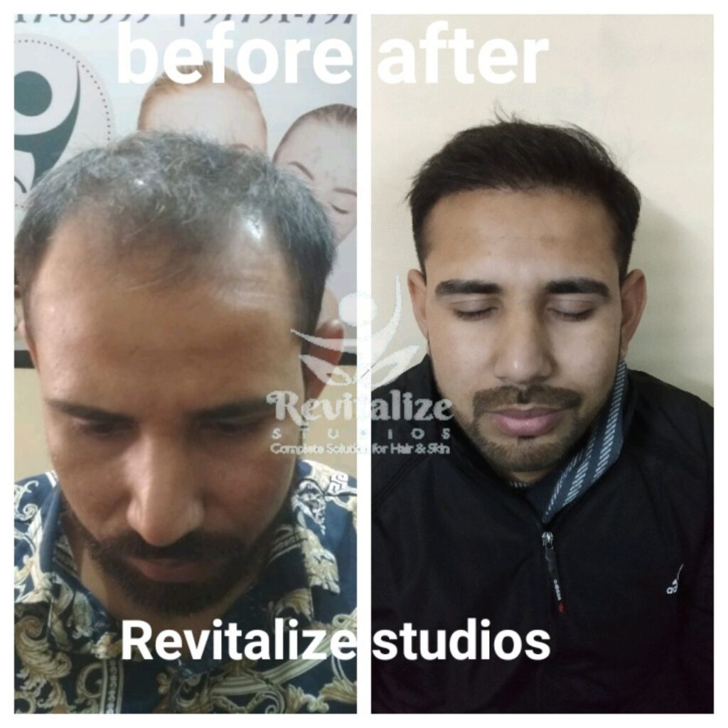 Hair Transplant Goraya, Hair Transplant Shankar, Hair Transplant Morinda, Hair Transplant Nakodar, Hair Transplant Lohian, Hair Transplant Basti Jodhewal, Hair Transplant Bhogpur, Hair Transplant Urmar, Hair Transplant Balachaur, Hair Transplant Sultanpur Lodhi, Hair Transplant Kapurthala, Hair Transplant Mehatpur, Hair Transplant Talwandi Bhai, Hair Transplant Dhilwan, Hair Transplant Sunam, Hair Transplant Rurka Kalan, Hair Transplant Phullanwal, Hair Transplant Mahilpur, Hair Transplant Bhawanigarh