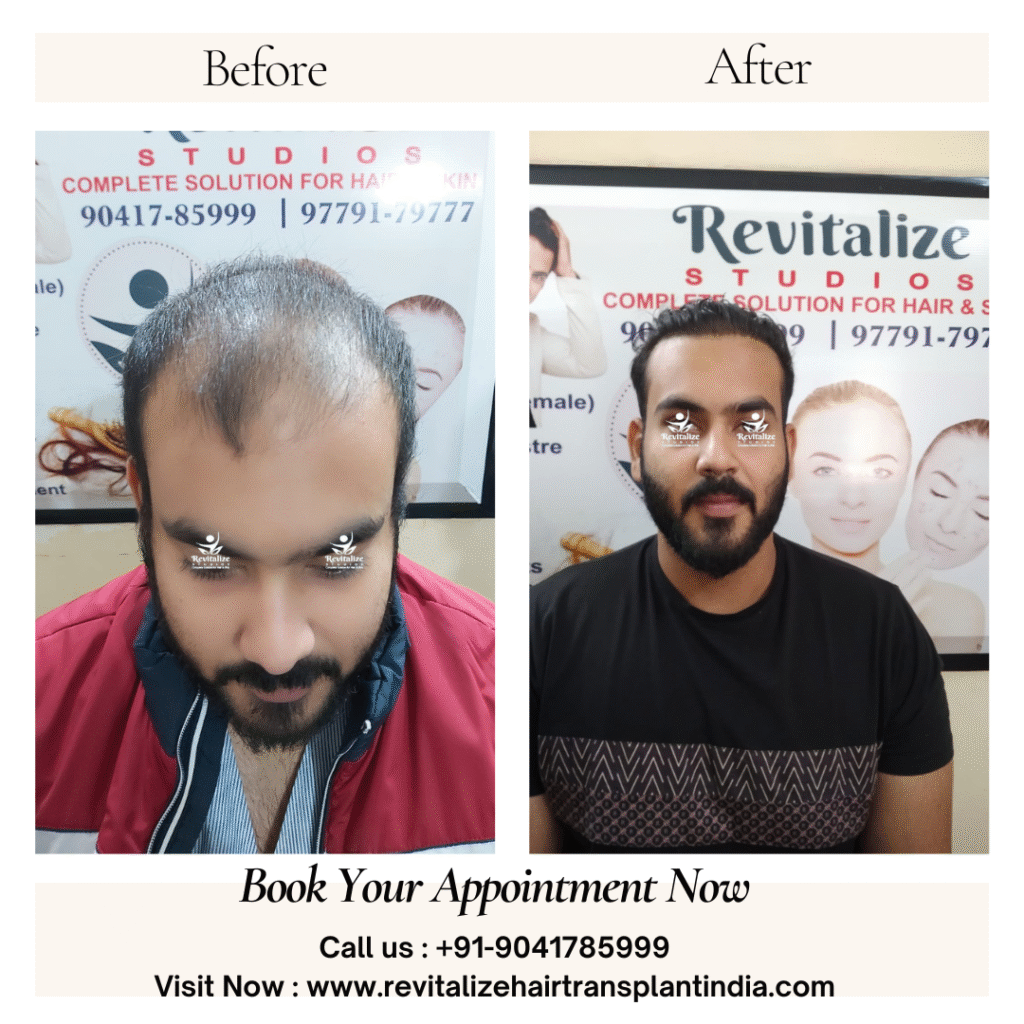 Young male hair transplant before and after results India