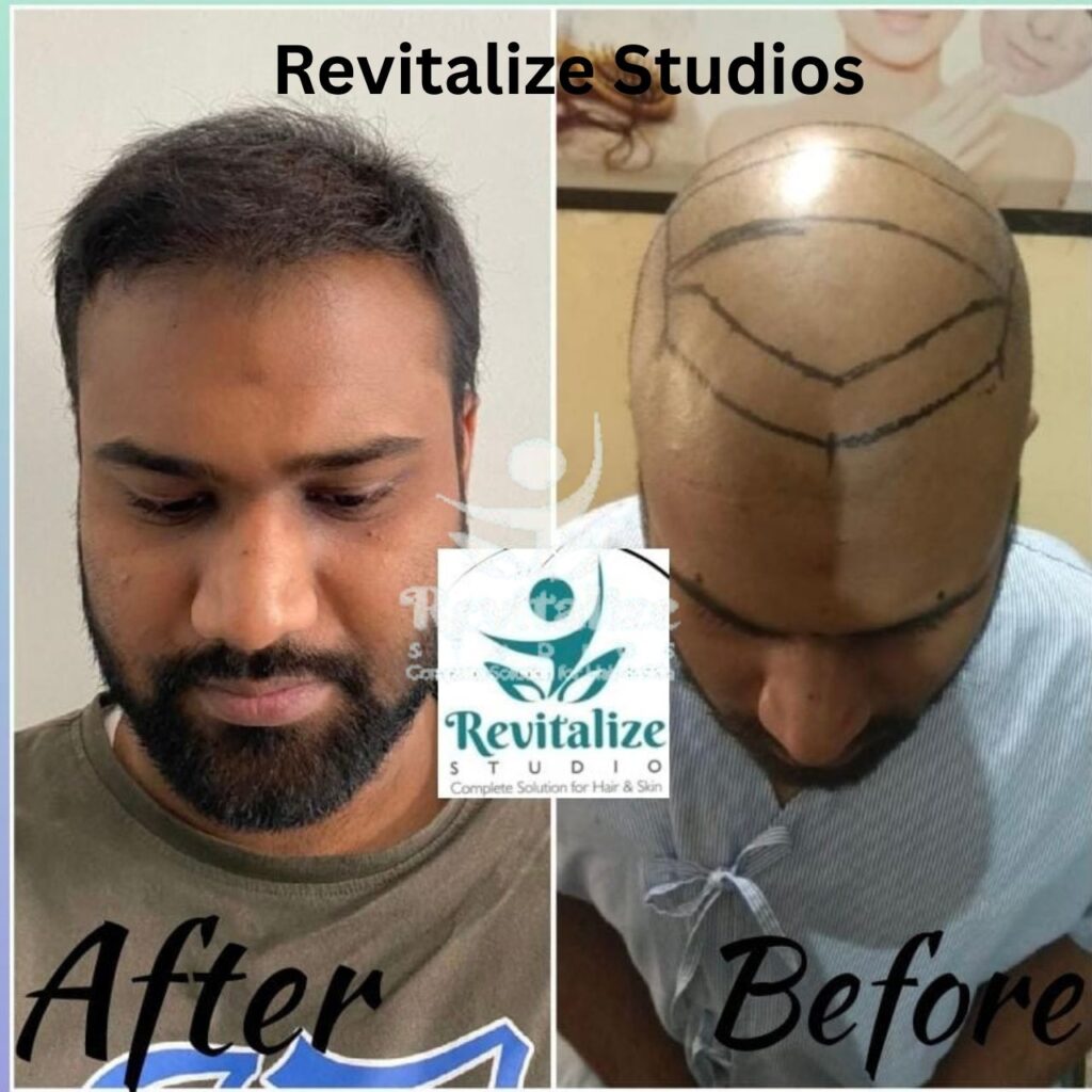 Hair Transplant Amritsar, Hair Transplant Jalandhar, Hair Transplant Ludhiana, Hair Transplant Pathankot, Hair Transplant Hoshiarpur, Hair Transplant Kapurthala, Hair Transplant Moga, Hair Transplant Firozpur, Hair Transplant Sangrur, Hair Transplant Tarn Taran, Hair Transplant Fatehgarh Sahib, Hair Transplant Muktsar, Hair Transplant Faridkot, Hair Transplant Ropar, Hair Transplant Rupnagar, Hair Transplant Barnala, Hair Transplant Fazilk