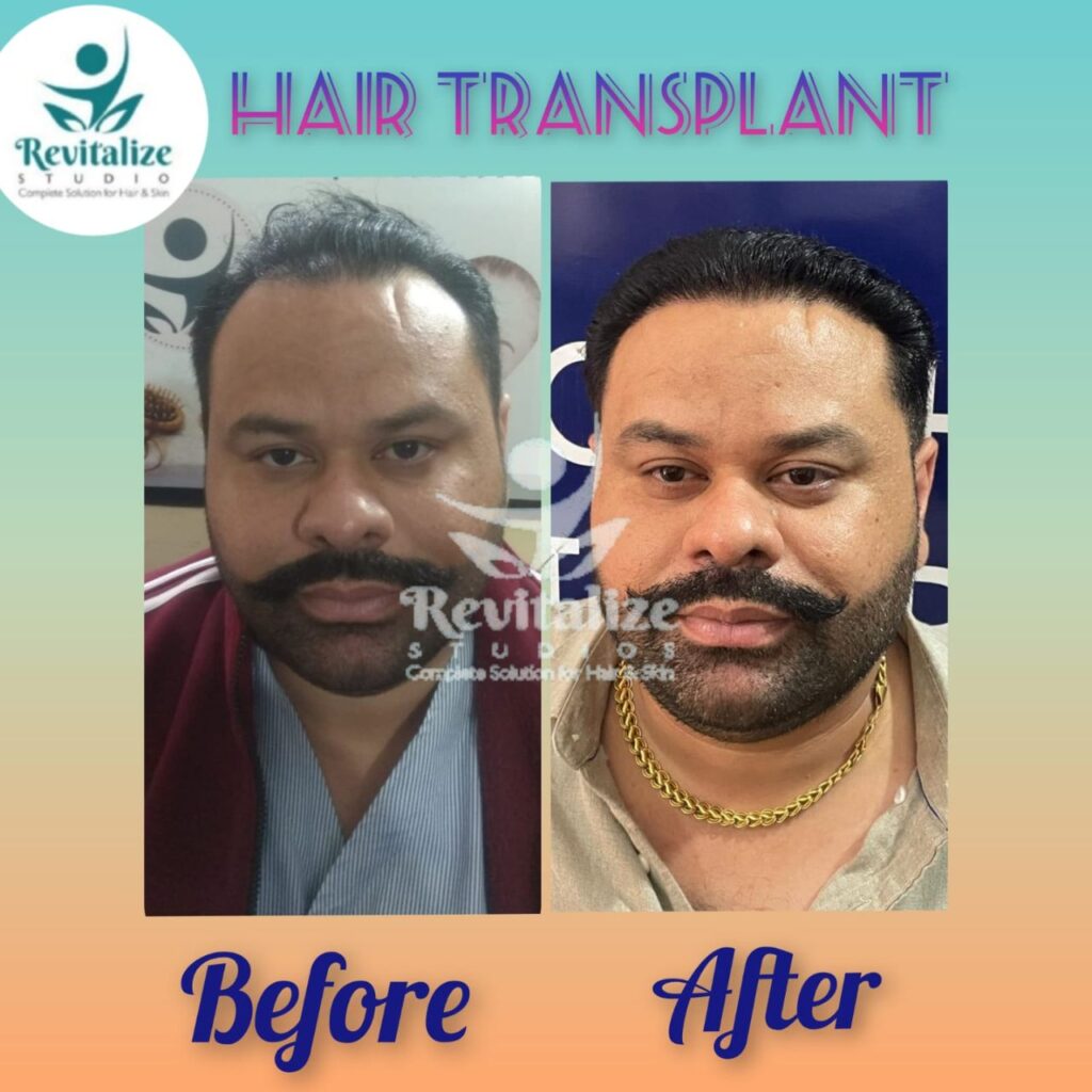 Hair Transplant Nabha, Hair Transplant Samrala, Hair Transplant Doraha, Hair Transplant Bassi Pathana, Hair Transplant Dera Bassi, Hair Transplant Banur, Hair Transplant Rajpura, Hair Transplant Kharar, Hair Transplant Zirakpur, Hair Transplant Derabassi, Hair Transplant Mohali, Hair Transplant Chandigarh, Hair Transplant Panchkula, Hair Transplant Patiala, Hair Transplant Bathinda, Hair Transplant Amritsar, Hair Transplant Jalandhar, Hair Transplant Ludhiana, Hair Transplant Pathankot, Hair Transplant Hoshiarpur, Hair Transplant Kapurthala, Hair Transplant Moga, Hair Transplant Firozpur, Hair Transplant Sangrur, Hair Transplant Tarn Taran, Hair Transplant Fatehgarh Sahib, Hair Transplant Muktsar, Hair Transplant Faridkot, Hair Transplant Ropar, Hair Transplant Rupnagar, Hair Transplant Barnala, Hair Transplant Fazilka, Hair Transplant Malerkotla, Hair Transplant Jagraon, Hair Transplant Abohar, Hair Transplant Mansa, Hair Transplant Zira, Hair Transplant Khamano, Hair Transplant Khanna, Hair Transplant Rajpura, Hair Transplant Nabha, Hair Transplant Samrala, Hair Transplant Doraha, Hair Transplant Bassi Pathana, Hair Transplant Dera Bassi, Hair Transplant Banur, Hair Transplant Rajpura, Hair Transplant Kharar, Hair Transplant Zirakpur, Hair Transplant Derabassi, Hair Transplant Mohali, Hair Transplant Chandigarh, Hair Transplant Panchkula, Hair Transplant Patiala, Hair Transplant Bathinda, Hair Transplant Amritsar, Hair Transplant Jalandhar, Hair Transplant Ludhiana, Hair Transplant Pathankot, Hair Transplant Hoshiarpur, Hair Transplant Kapurthala, Hair Transplant Moga,