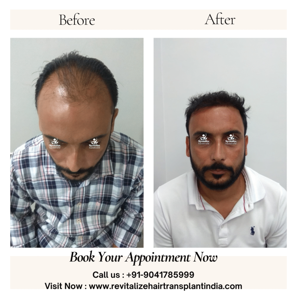 PRP with hair transplant before and after results India