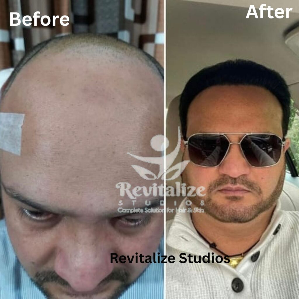 Hair Transplant Khanna, Hair Transplant Rajpura, Hair Transplant Nabha, Hair Transplant Samrala, Hair Transplant Doraha, Hair Transplant Bassi Pathana, Hair Transplant Dera Bassi, Hair Transplant Banur, Hair Transplant Rajpura, Hair Transplant Kharar, Hair Transplant Zirakpur, Hair Transplant Derabassi, Hair Transplant Mohali, Hair Transplant Chandigarh, Hair Transplant Panchkula, Hair Transplant Patiala, Hair Transplant Bathinda,