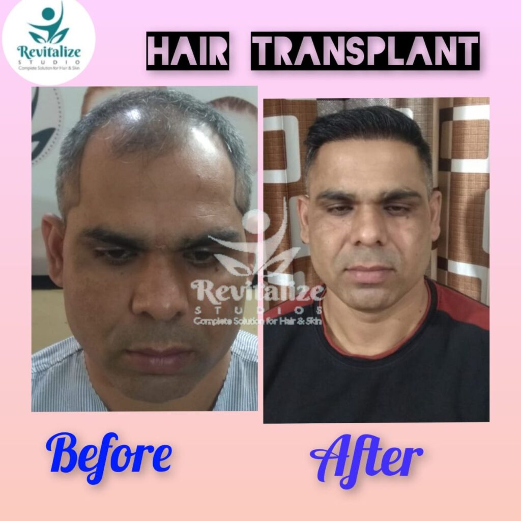 Hair Transplant Firozpur, Hair Transplant Sangrur, Hair Transplant Tarn Taran, Hair Transplant Fatehgarh Sahib, Hair Transplant Muktsar, Hair Transplant Faridkot, Hair Transplant Ropar, Hair Transplant Rupnagar, Hair Transplant Barnala, Hair Transplant Fazilka, Hair Transplant Malerkotla, Hair Transplant Jagraon, Hair Transplant Abohar, Hair Transplant Mansa, Hair Transplant Zira, Hair Transplant Khamano, Hair Transplant Khanna, Hair Transplant Rajpura, Hair Transplant Nabha, Hair Transplant Samrala, Hair Transplant Doraha, Hair Transplant Bassi Pathana, Hair Transplant Dera Bassi, Hair Transplant Banur, Hair Transplant Rajpura, Hair Transplant Kharar, Hair Transplant Zirakpur, Hair Transplant Derabassi, Hair Transplant Mohali, Hair Transplant Chandigarh, Hair Transplant Panchkula, Hair Transplant Patiala, Hair Transplant Bathinda, Hair Transplant Amritsar, Hair Transplant Jalandhar, Hair Transplant Ludhiana, Hair Transplant Pathankot, Hair Transplant Hoshiarpur, Hair Transplant Kapurthala, Hair Transplant Moga, Hair Transplant Firozpur, Hair Transplant Sangrur, Hair Transplant Tarn Taran, Hair Transplant Fatehgarh Sahib, Hair Transplant Muktsar, Hair Transplant Faridkot, Hair Transplant Ropar, Hair Transplant Rupnagar, Hair Transplant Barnala, Hair Transplant Fazilka, Hair Transplant Malerkotla, Hair Transplant Jagraon, Hair Transplant Abohar, Hair Transplant Mansa, Hair Transplant Zira, Hair Transplant Khamano, Hair Transplant Khanna, Hair Transplant Rajpura, Hair Transplant Nabha, Hair Transplant Samrala, Hair Transplant Doraha, Hair Transplant Bassi Pathana, Hair Transplant Dera Bassi, Hair Transplant Banur, Hair Transplant Rajpura, Hair Transplant Kharar, Hair Transplant Zirakpur, Hair Transplant Derabassi, Hair Transplant Mohali, Hair Transplant Chandigarh, Hair Transplant Panchkula, Hair Transplant Patiala, Hair Transplant Bathinda, Hair Transplant Amritsar, Hair Transplant Jalandhar, Hair Transplant Ludhiana, Hair Transplant Pathankot, Hair Transplant Hoshiarpur, Hair Transplant Kapurthala, Hair Transplant Moga, Hair Transplant Firozpur, Hair Transplant Sangrur, Hair Transplant Tarn Taran, Hair Transplant Fatehgarh Sahib, Hair Transplant Muktsar, Hair Transplant Faridkot, Hair Transplant Ropar, Hair Transplant Rupnagar,