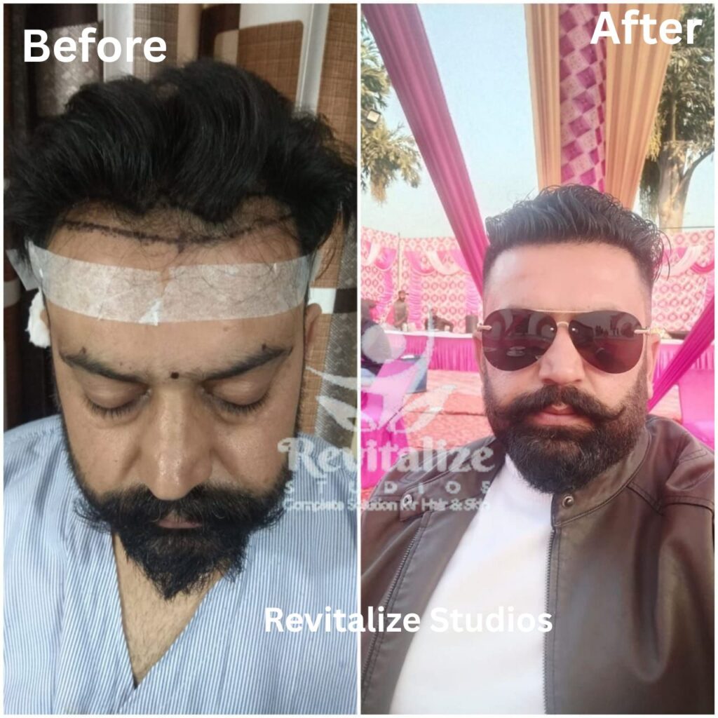 Hair Transplant Moga, Hair Transplant Firozpur, Hair Transplant Sangrur, Hair Transplant Tarn Taran, Hair Transplant Fatehgarh Sahib, Hair Transplant Muktsar, Hair Transplant Faridkot, Hair Transplant Ropar, Hair Transplant Rupnagar, Hair Transplant Barnala, Hair Transplant Fazilka, Hair Transplant Malerkotla, Hair Transplant Jagraon, Hair Transplant Abohar, Hair Transplant Mansa, Hair Transplant Zira, Hair Transplant Khamano,