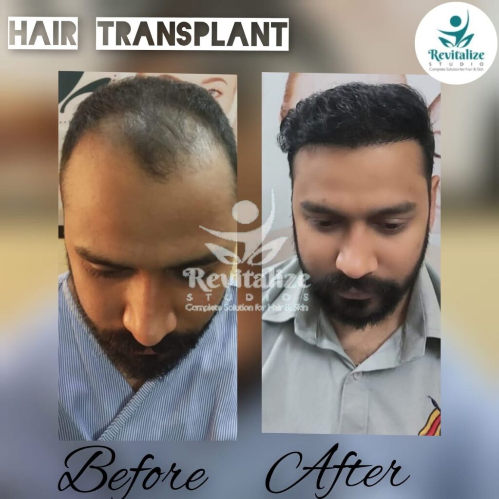 Hair Transplant Kartarpur, Hair Transplant Nurmahal, Hair Transplant Adampur, Hair Transplant Jandiala, Hair Transplant Goraya, Hair Transplant Shankar, Hair Transplant Morinda, Hair Transplant Nakodar, Hair Transplant Lohian, Hair Transplant Basti Jodhewal, Hair Transplant Bhogpur, Hair Transplant Urmar, Hair Transplant Balachaur, Hair Transplant Sultanpur Lodhi, Hair Transplant Kapurthala, Hair Transplant Mehatpur, Hair Transplant Talwandi Bhai, Hair Transplant Dhilwan, Hair Transplant Sunam, Hair Transplant Rurka Kalan, Hair Transplant Phullanwal, Hair Transplant Mahilpur, Hair Transplant Bhawanigarh