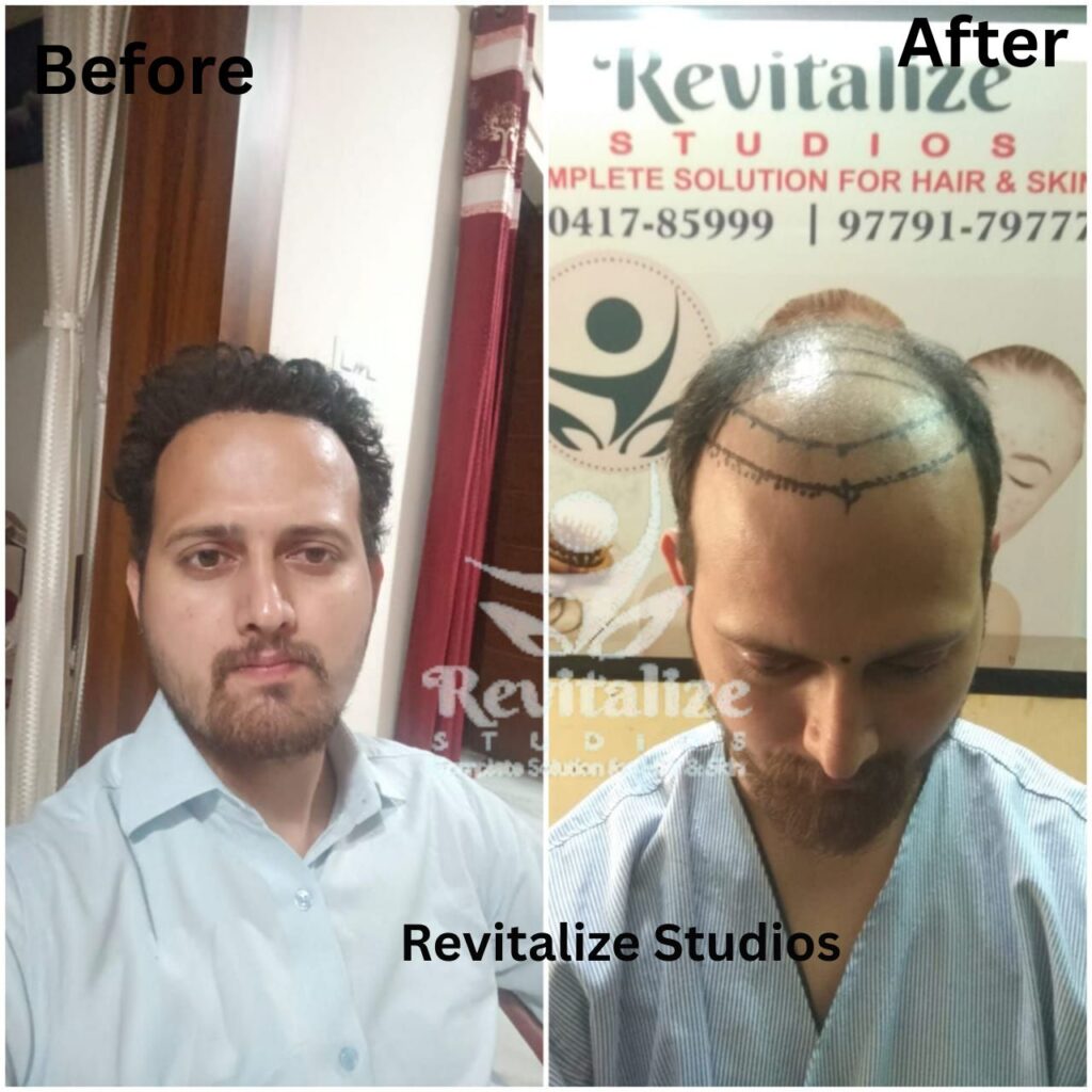 Hair Transplant Sujanpur, Hair Transplant Abrol Nagar, Hair Transplant Mission Road, Hair Transplant Badhani, Hair Transplant Pinjore, Hair Transplant Bungal, Hair Transplant Haryal, Hair Transplant Jandwal, Hair Transplant Municipal Colony, Hair Transplant Shahpur Kandi, Hair Transplant Dharkalan