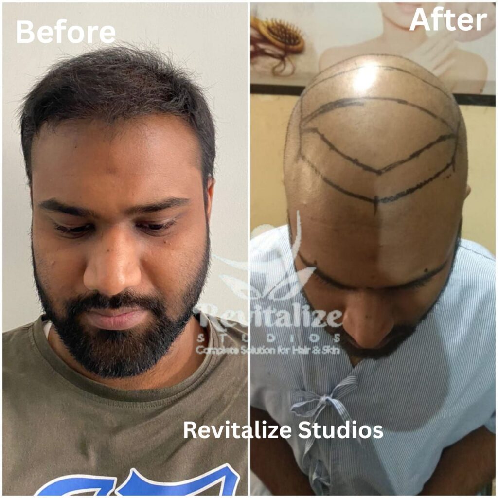 Hair Transplant Barnala, Hair Transplant Fazilka, Hair Transplant Malerkotla, Hair Transplant Jagraon, Hair Transplant Abohar, Hair Transplant Mansa, Hair Transplant Zira, Hair Transplant Khamano, Hair Transplant Khanna, Hair Transplant Rajpura, Hair Transplant Nabha, Hair Transplant Samrala, Hair Transplant Doraha, Hair Transplant Bassi Pathana, Hair Transplant Dera Bassi, Hair Transplant Banur, Hair Transplant Rajpura,