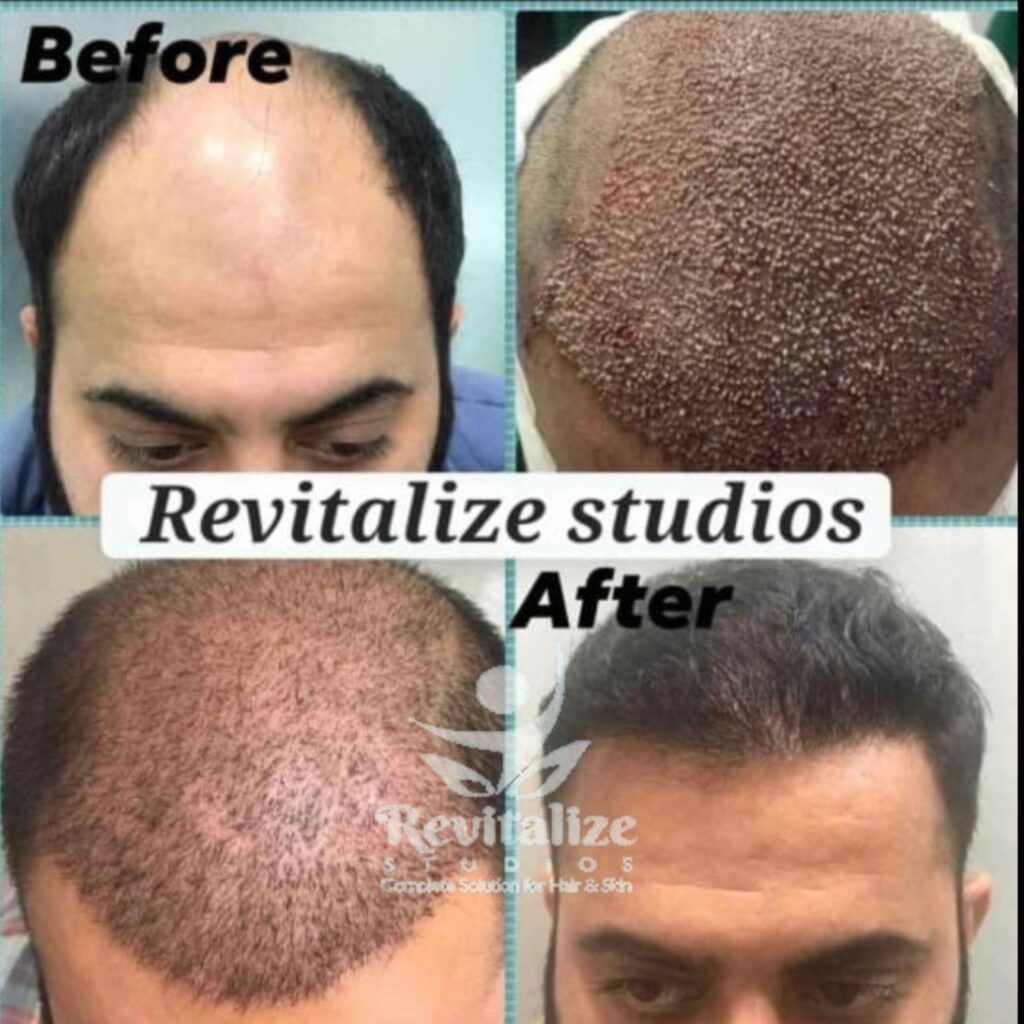 Hair Transplant Firozpur, Hair Transplant Sangrur, Hair Transplant Tarn Taran, Hair Transplant Fatehgarh Sahib, Hair Transplant Muktsar, Hair Transplant Faridkot, Hair Transplant Ropar, Hair Transplant Rupnagar, Hair Transplant Barnala, Hair Transplant Fazilka, Hair Transplant Malerkotla, Hair Transplant Jagraon, Hair Transplant Abohar, Hair Transplant Mansa, Hair Transplant Zira, Hair Transplant Khamano, Hair Transplant Khanna, Hair Transplant Rajpura, Hair Transplant Nabha, Hair Transplant Samrala, Hair Transplant Doraha, Hair Transplant Bassi Pathana, Hair Transplant Dera Bassi, Hair Transplant Banur, Hair Transplant Rajpura, Hair Transplant Kharar, Hair Transplant Zirakpur, Hair Transplant Derabassi, Hair Transplant Mohali, Hair Transplant Chandigarh, Hair Transplant Panchkula, Hair Transplant Patiala, Hair Transplant Bathinda, Hair Transplant Amritsar, Hair Transplant Jalandhar, Hair Transplant Ludhiana, Hair Transplant Pathankot, Hair Transplant Hoshiarpur, Hair Transplant Kapurthala, Hair Transplant Moga, Hair Transplant Firozpur, Hair Transplant Sangrur, Hair Transplant Tarn Taran, Hair Transplant Fatehgarh Sahib, Hair Transplant Muktsar, Hair Transplant Faridkot, Hair Transplant Ropar, Hair Transplant Rupnagar, Hair Transplant Barnala, Hair Transplant Fazilka, Hair Transplant Malerkotla, Hair Transplant Jagraon, Hair Transplant Abohar, Hair Transplant Mansa, Hair Transplant Zira, Hair Transplant Khamano, Hair Transplant Khanna, Hair Transplant Rajpura, Hair Transplant Nabha, Hair Transplant Samrala, Hair Transplant Doraha, Hair Transplant Bassi Pathana, Hair Transplant Dera Bassi, Hair Transplant Banur, Hair Transplant Rajpura, Hair Transplant Kharar, Hair Transplant Zirakpur, Hair Transplant Derabassi, Hair Transplant Mohali, Hair Transplant Chandigarh, Hair Transplant Panchkula, Hair Transplant Patiala, Hair Transplant Bathinda, Hair Transplant Amritsar, Hair Transplant Jalandhar, Hair Transplant Ludhiana, Hair Transplant Pathankot, Hair Transplant Hoshiarpur, Hair Transplant Kapurthala, Hair Transplant Moga, Hair Transplant Firozpur, Hair Transplant Sangrur, Hair Transplant Tarn Taran, Hair Transplant Fatehgarh Sahib, Hair Transplant Muktsar, Hair Transplant Faridkot, Hair Transplant Ropar, Hair Transplant Rupnagar,