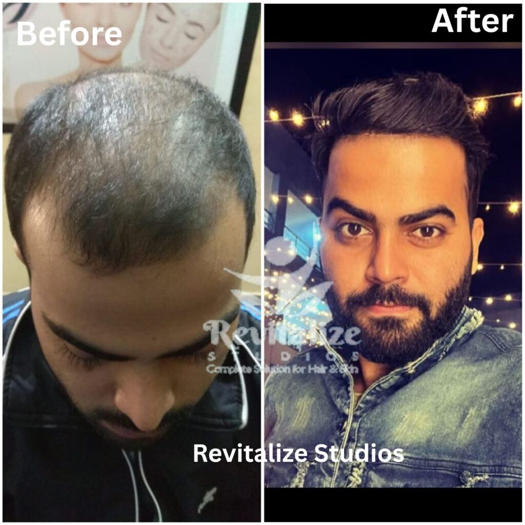 Hair Transplant Dera Bassi, Hair Transplant Banur, Hair Transplant Rajpura, Hair Transplant Kharar, Hair Transplant Zirakpur, Hair Transplant Derabassi, Hair Transplant Mohali, Hair Transplant Chandigarh, Hair Transplant Panchkula, Hair Transplant Patiala, Hair Transplant Bathinda, Hair Transplant Amritsar, Hair Transplant Jalandhar, Hair Transplant Ludhiana, Hair Transplant Pathankot, Hair Transplant Hoshiarpur, Hair Transplant Kapurthala, Hair Transplant Moga, Hair Transplant Firozpur, Hair Transplant Sangrur, Hair Transplant Tarn Taran, Hair Transplant Fatehgarh Sahib, Hair Transplant Muktsar, Hair Transplant Faridkot, Hair Transplant Ropar, Hair Transplant Rupnagar