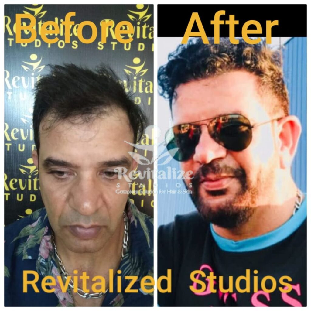 ASG Hair Transplant Pathankot, Studio Folligrow Pathankot, Hair Transplant Punjab, Hair Transplant Near Pathankot Villages, Hair Transplant Bhoa, Hair Transplant Bharoli Kalan, Hair Transplant Tharial, Hair Transplant Kataruchak, Hair Transplant Ranipur, Hair Transplant Jandwal, Hair Transplant Sarna, Hair Transplant Dunera, Hair Transplant Shahpur Kandi, Hair Transplant Mamoon, Hair Transplant Dhangu Road