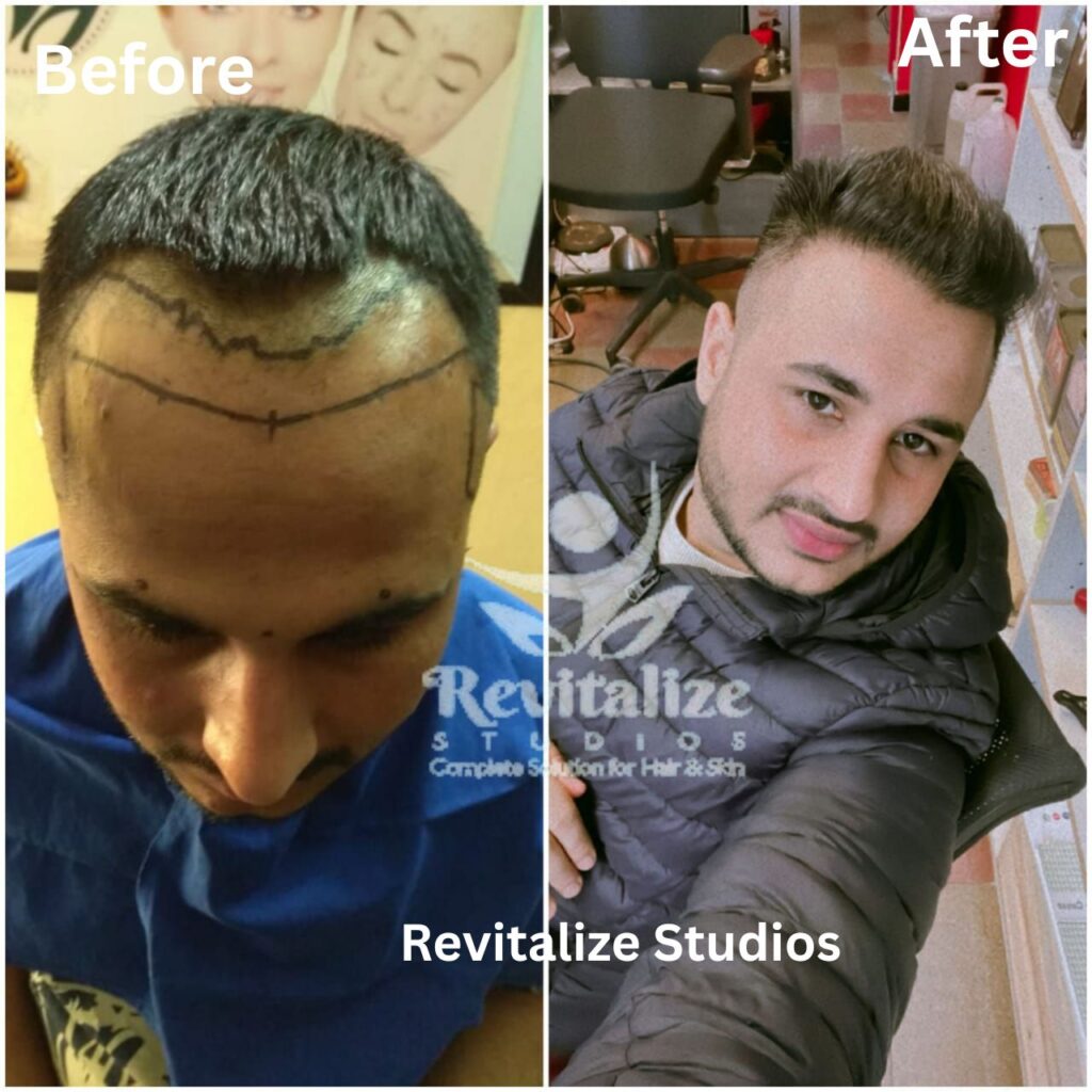 Hair Transplant Ropar, Hair Transplant Rupnagar, Hair Transplant Barnala, Hair Transplant Fazilka, Hair Transplant Malerkotla, Hair Transplant Jagraon, Hair Transplant Abohar, Hair Transplant Mansa, Hair Transplant Zira, Hair Transplant Khamano, Hair Transplant Khanna, Hair Transplant Rajpura, Hair Transplant Nabha, Hair Transplant Samrala, Hair Transplant Doraha, Hair Transplant Bassi Pathana, Hair Transplant Dera Bassi, Hair Transplant Banur, Hair Transplant Rajpura, Hair Transplant Kharar, Hair Transplant Zirakpur, Hair Transplant Derabassi, Hair Transplant Mohali, Hair Transplant Chandigarh, Hair Transplant Panchkula, Hair Transplant Patiala,