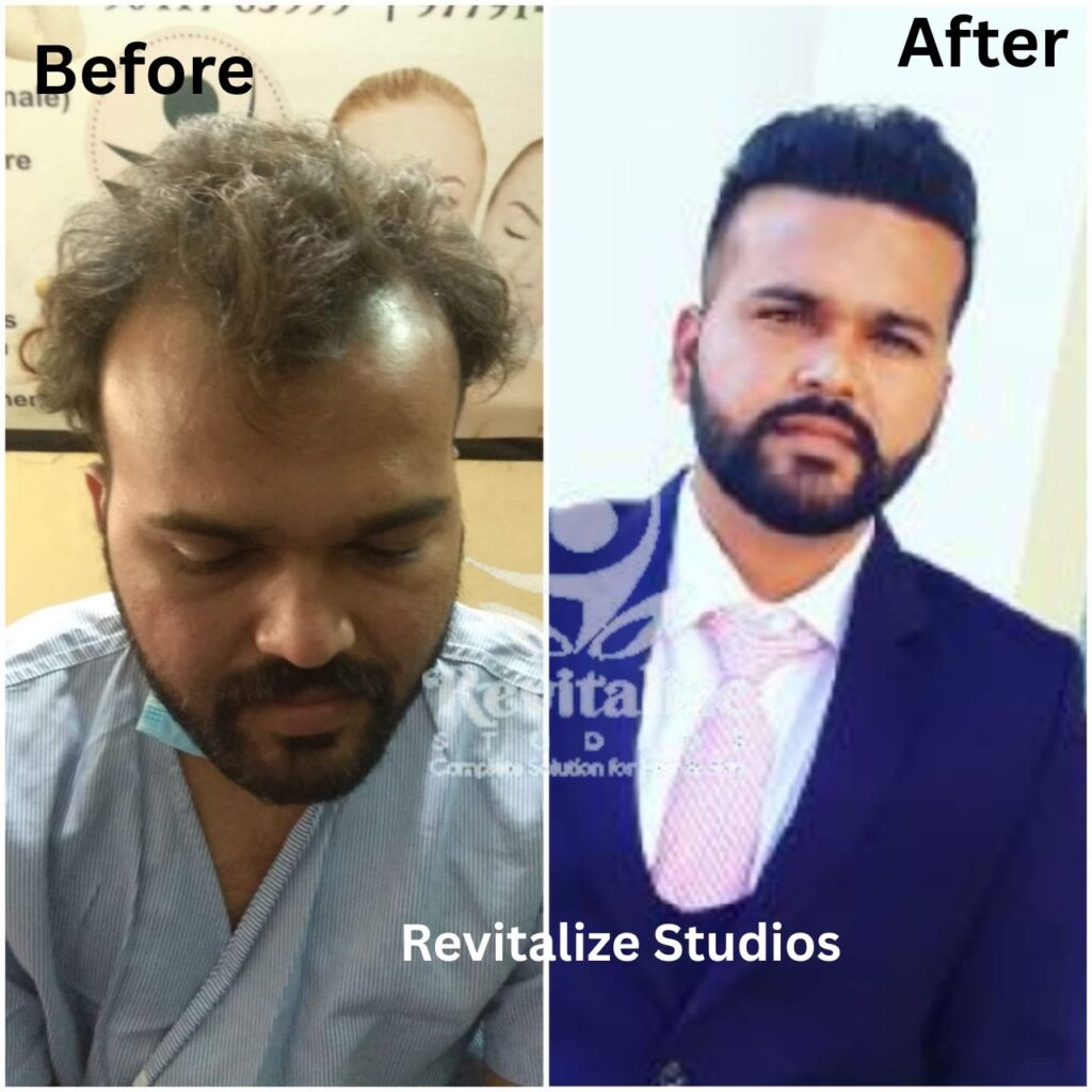 Hair Transplant Punjab, Hair Transplant Near Me, Hair Transplant Clinic Punjab, Best Hair Transplant Punjab, Affordable Hair Transplant Punjab, FUE Hair Transplant Punjab, FUT Hair Transplant Punjab, Beard Transplant Punjab, Eyebrow Hair Transplant Punjab, Hair Loss Treatment Punjab, Hair Restoration Punjab, Hair Transplant Ludhiana, Hair Transplant Amritsar, Hair Transplant Jalandhar, Hair Transplant Patiala, Hair Transplant Bathinda, Hair Transplant Mohali, Hair Transplant Moga, Hair Transplant Kapurthala, Hair Transplant Hoshiarpur, Hair Transplant Pathankot, Hair Transplant Firozpur, Hair Transplant Sangrur, Hair Transplant Tarn Taran, Hair Transplant Fatehgarh Sahib, Hair Transplant Muktsar, Hair Transplant Faridkot,