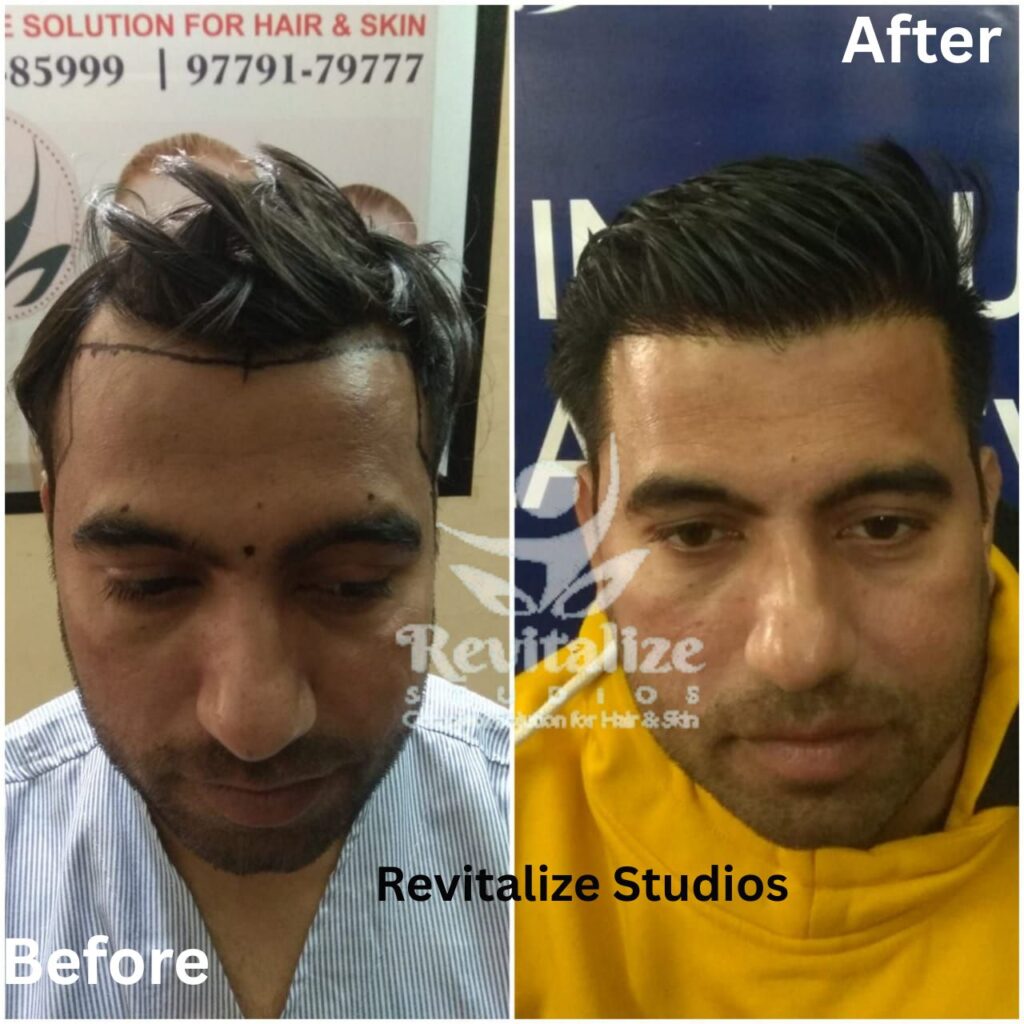Hair Transplant Punjab, Hair Transplant Near Jalandhar Villages, Hair Transplant Phagwara, Hair Transplant Kartarpur, Hair Transplant Nurmahal, Hair Transplant Adampur, Hair Transplant Jandiala, Hair Transplant Goraya