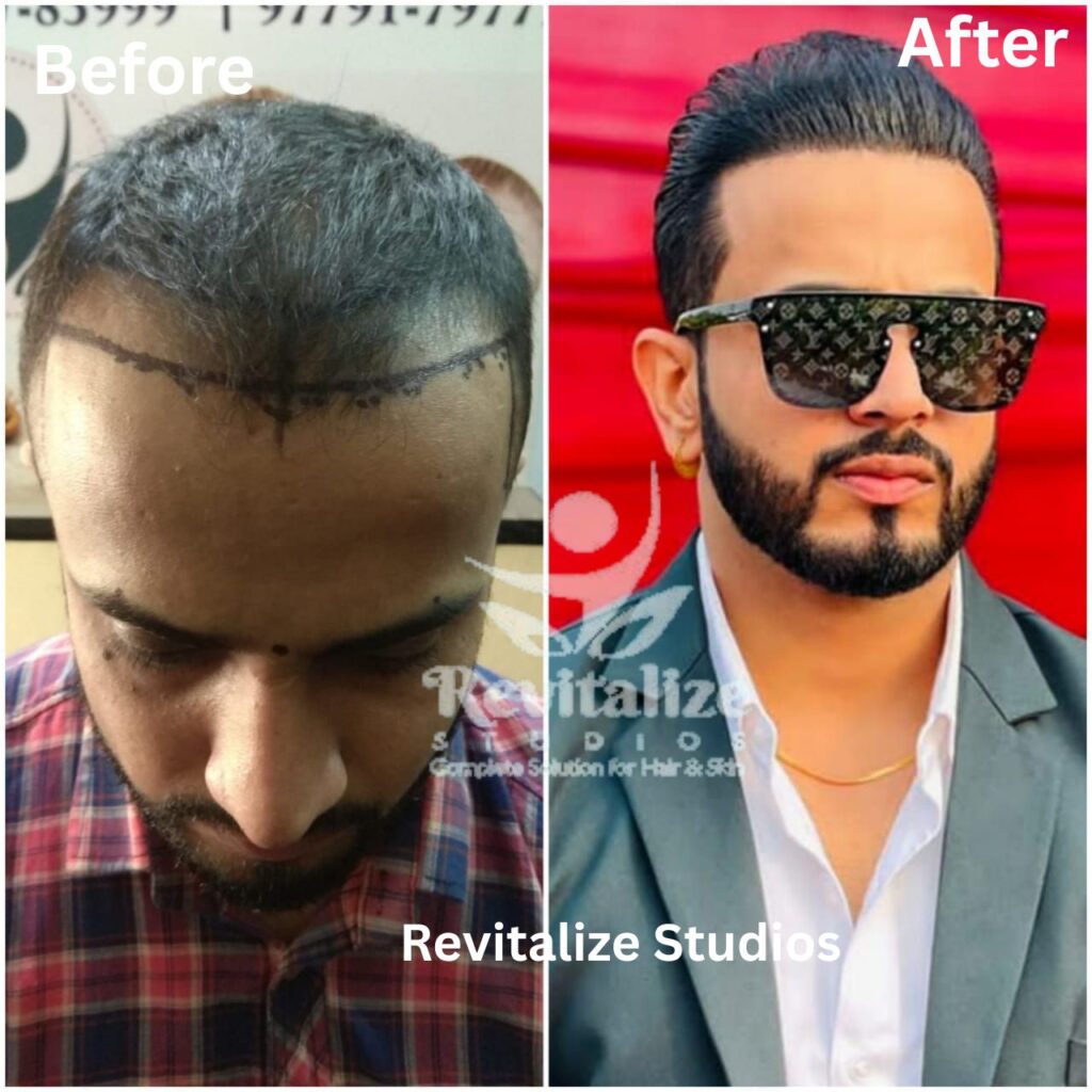 fue hair transplant in jalandhar