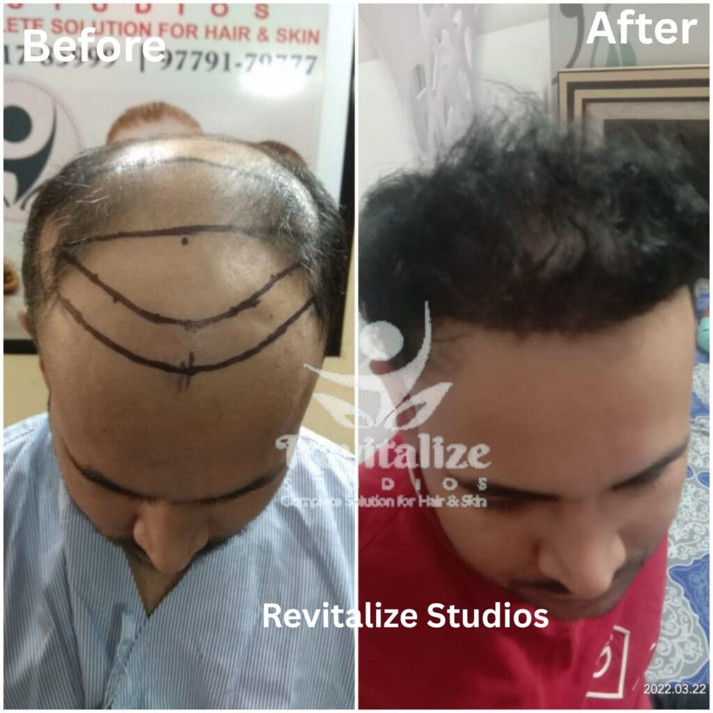Hair Transplant Pathankot, Hair Transplant Near Me, Hair Transplant Clinic Pathankot, Best Hair Transplant Pathankot, Affordable Hair Transplant Pathankot, FUE Hair Transplant Pathankot, FUT Hair Transplant Pathankot, Beard Transplant Pathankot, Eyebrow Hair Transplant Pathankot, Hair Loss Treatment Pathankot, Hair Restoration Pathankot, Revitalize Studios Pathankot