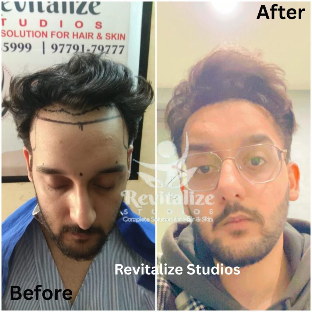 Hair Transplant Jalandhar, Hair Transplant Near Me, Hair Transplant Clinic Jalandhar, Best Hair Transplant Jalandhar, Affordable Hair Transplant Jalandhar, FUE Hair Transplant Jalandhar, FUT Hair Transplant Jalandhar, Beard Transplant Jalandhar, Eyebrow Hair Transplant Jalandhar, Hair Loss Treatment Jalandhar, Hair Restoration Jalandhar, Revitalize Studios Hair Transplant Jalandhar,