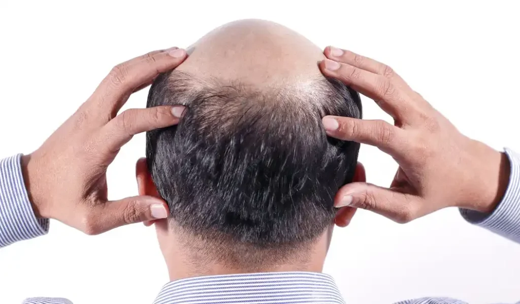 hair trannsplant treatment in jalandhar