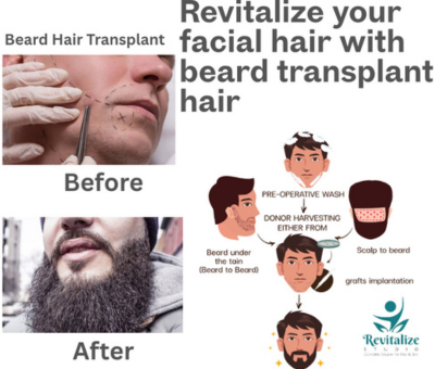 Beard Hair Transplant Jalandhar Beard Hair Transplant Jalandhar