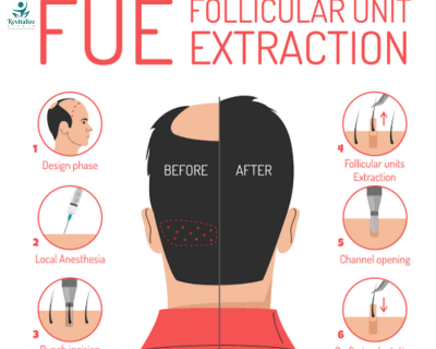 FUE Hair Transplant in Jalandhar FUE Hair Transplant in jalandhar, hair tra