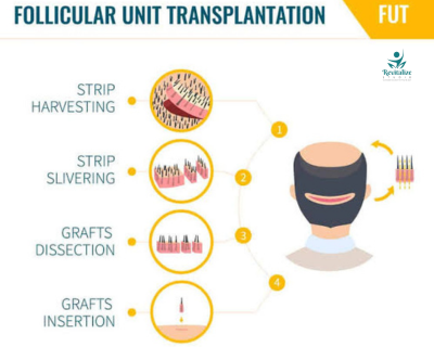 FUT Hair Transplant In Jalandhar FUT Hair Transplant In Jalandhar